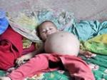Doktori šokirani: Jednogodišnja kineska djevojčica nosi bebu blizanca