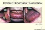 Nasledna hemoragijska teleangiektazija