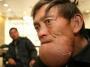 Čovek-brada: Kinez sa retkim oboljenjem