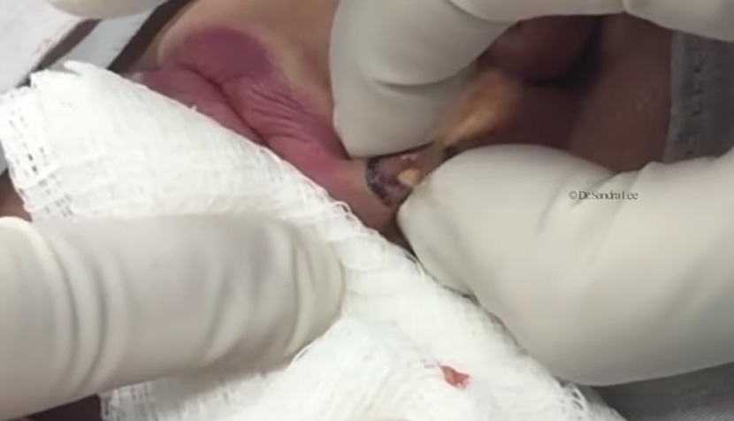 Iznad gornje usne joj se pojavila kvrgica, a kad ju je doktorka rasekela izleteo je UŽAS! (VIDEO)