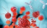 Lekari šokirani: Ovo ubija 93 odsto ćelija raka debelog creva za samo 2 dana?