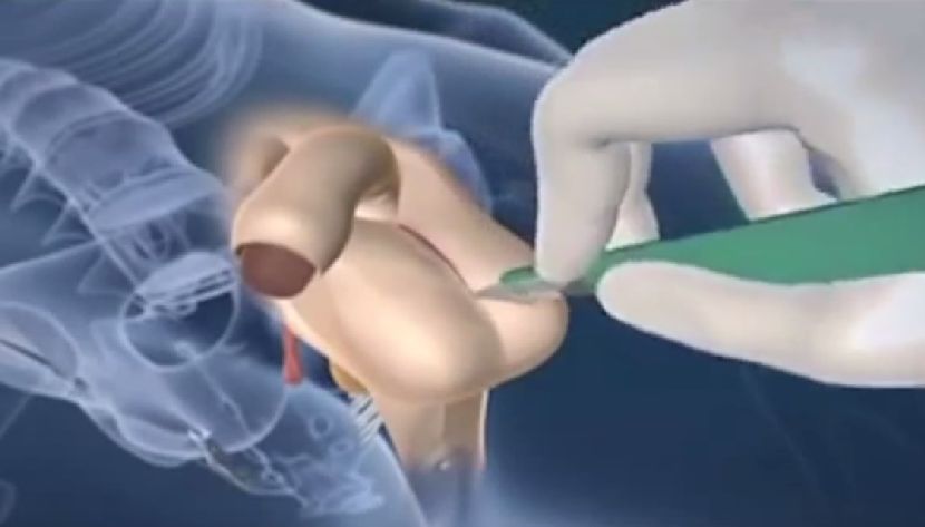 NIKAD VIĐENO: Ovako izgleda operacija promene pola, kad muškarac postaje žena (VIDEO)