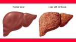Šta je ciroza jetre i kako nastaje ciroza jetre