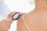 U Srbiji sve veći broj žena oboleva od melanoma kože
