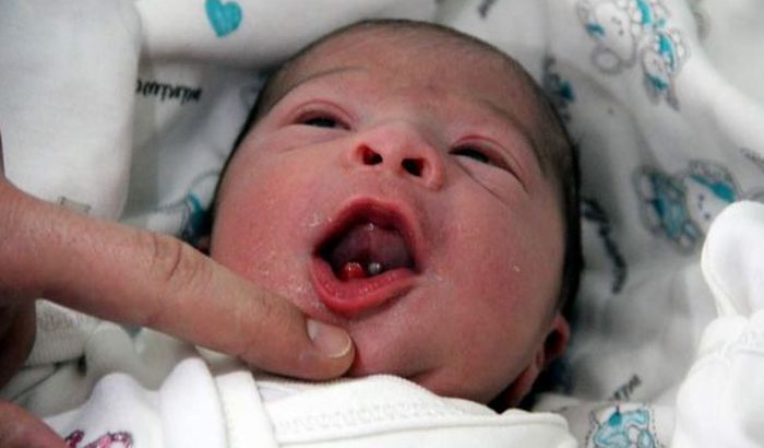 U Turskoj rođena beba sa dva prednja zuba