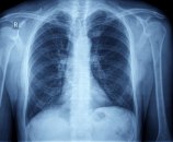 U poslednjih 10 godina smanjen broj obolelih od tuberkuloze