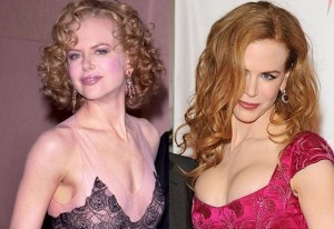 Vraća staro poprsje: Nicole Kidman vadi ‘otrovne’ silikone iz grudi