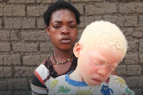 ZAUSTAVITE BRUTALNA UBISTVA Evropski parlament pozvao na prestanak progona albino ljudi
