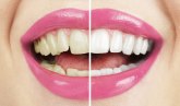 Žuti zubi: Da li su znak za uzbunu ili ne?