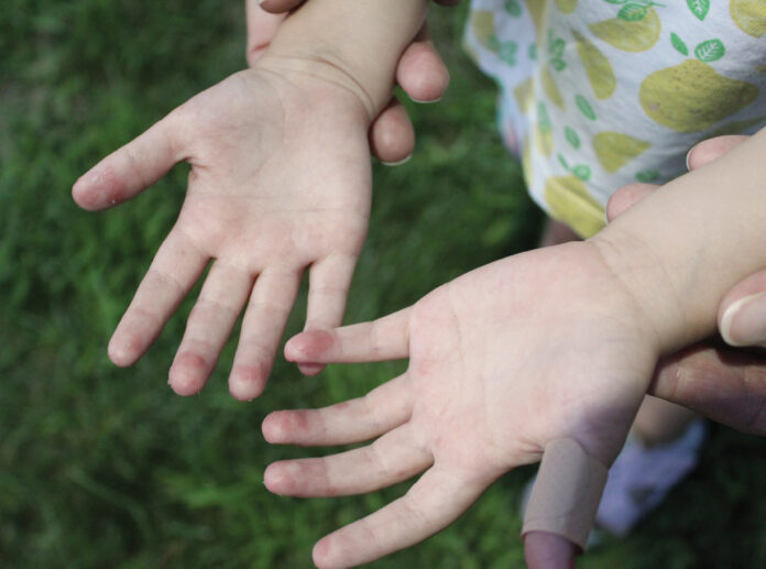 Besplatno savetovalište za atopijski ekcem u četvrtak u Nišu