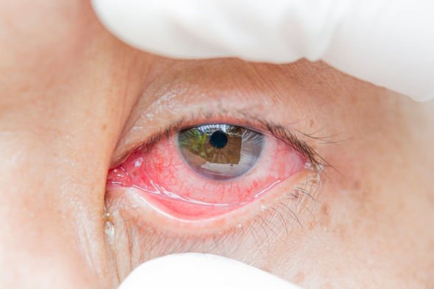 Crvene oči mogu biti znak da je pacijent zaražen koronavirusom