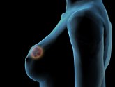 Čudesni lek za rak dojke usporava širenje bolesti