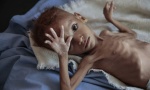 DECA MASOVNO UMIRU PRED OČIMA SVETA: Od gladi i bolesti stradalo 85.000 mališana u Jemenu?