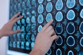 Da li stimulacija mozga pomaže osobama sa demencijom?
