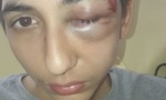 Dečaka (14) iz Srbije policajci pretukli u Parizu: Izbili mu TRI zuba, doktori se bore da mu SPASU oko