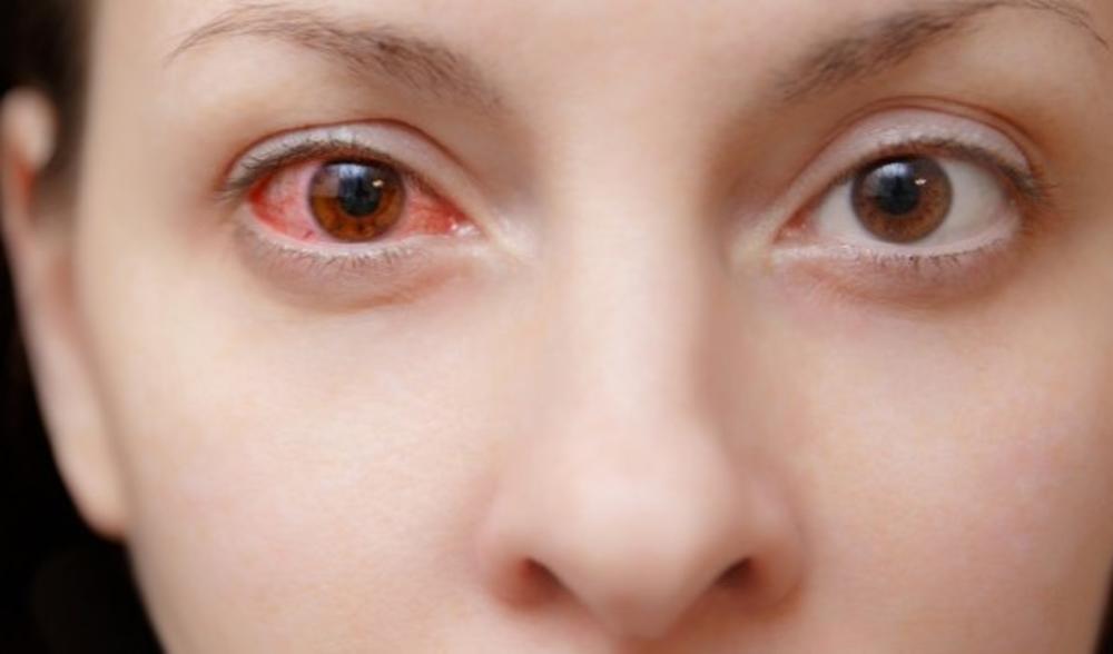 EPIDEMIJA AGRESIVNOG OČNOG GRIPA U AUSTRIJI: Zarazna infekcija ubrzano se širi,  a može trajno da ošteti vid!
