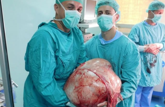 (FOTO) IZVADILI CUDOVISTE IZ STOMAKA Banjalucki lekari odstranili tumor tezak 31 kilogram