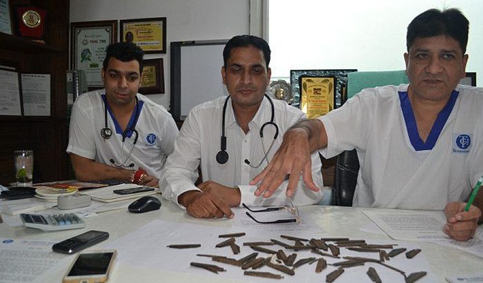 FOTO: Indijcu iz stomaka hirurzi izvadili 40 noževa