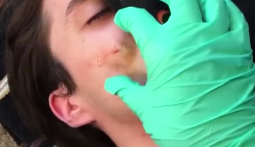 Gnoj iz obraza je izlazio kao da ga istiskaju iz paste za zube! Ovo je NAJODVRATNIJI klip koji ste ikada videli (VIDEO)