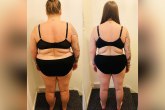 Gojaznost i zdravlje: Do čega sve dovode nesmotrene“ operacije za gubitak kilograma
