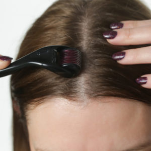 Gubitak kose: Može li mikronidling da spreči opadanje kose