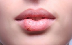 
					Herpes ne smete prikrivati šminkom 
					
									
