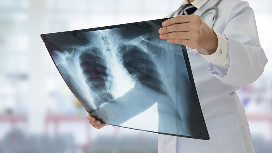 Hronična opstruktivna bolest pluća peti najčešći uzrok smrti