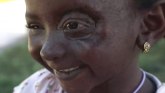 Jemen: Kako je šestogodišnjakinja pobedila rak, dobila novo oko i novu životnu šansu