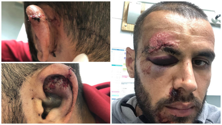 Jezive fotografije albanskog fudbalera koga su u Hrvatskoj pretukli štanglom! Zatvoreno mu oko,a koža oguljena sa čela!