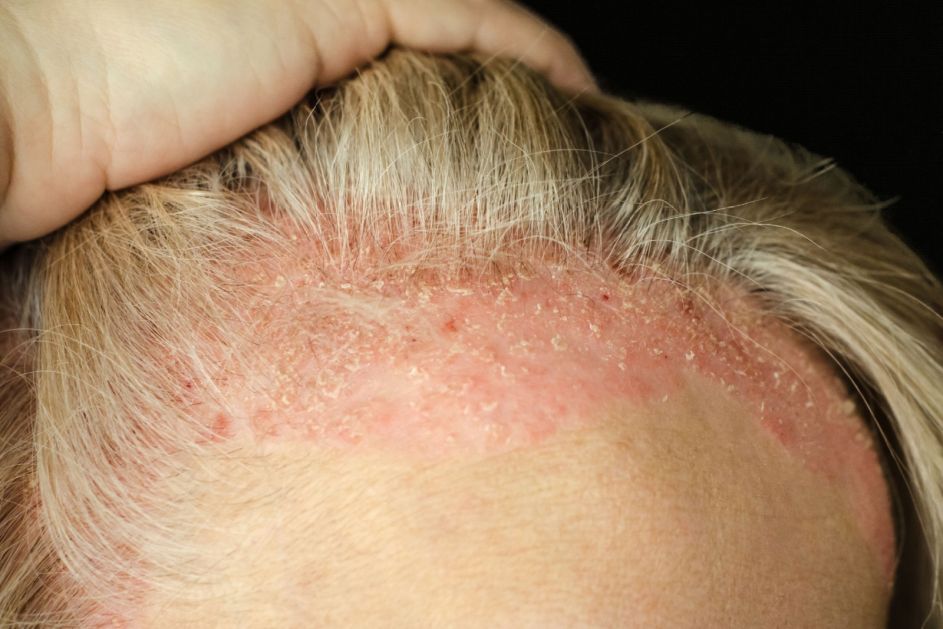 Kako da prepoznate početak psorijaze: Prvi simptomi na rukama, noktima i vlasištu