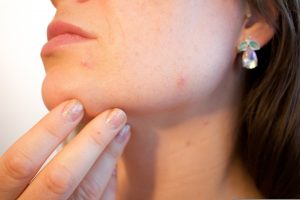 Kako da se šminkate ako imate akne: Dermatolozi otkrili šta je najvažnije, jednu grešku sa puderom svi prave