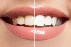 Kako jednostavno i efikasno izbeliti zube bez odlaska kod stomatologa