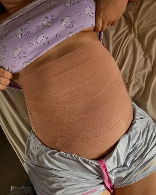 Kinesio traka u trudnoći je sve viralniji trend, evo kako funkcioniše i kada se koristi