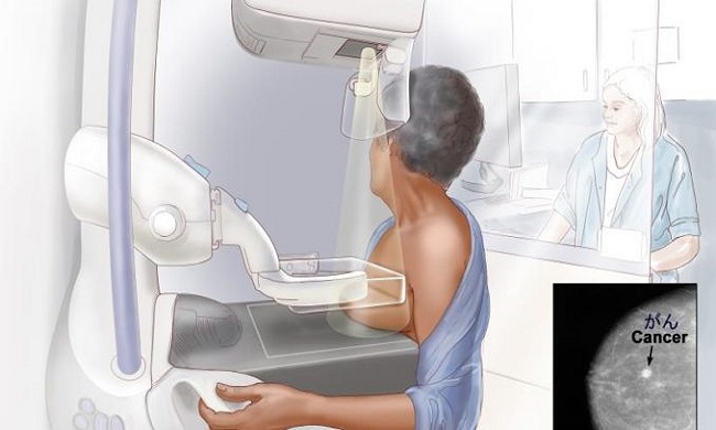 Klinički centar Niš organizuje besplatne mamografske preglede