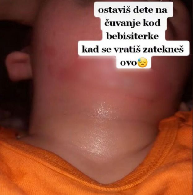 Mama iz Leskovca ostavila sina s dadiljom i zatekla ga u opekotinama kad se vratila (FOTO)