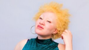 „Moj silovatelj je verovao da će ga napad na albino osobu zaštititi od bolesti“
