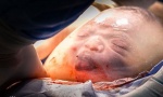NEVEROVATAN PRIZOR: Rođena “beba u balonu” (FOTO)