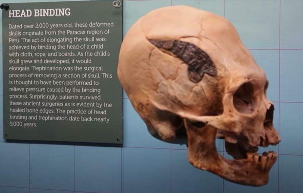 NEVEROVATNO OTKRIĆE: Ratnik iz Perua star 2000 godina imao metalni implant na glavi, preživeo i tu operaciju i izduživanje lobanje