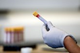 Na KiM još 11 žrtava koronavirusa, 141 novooboleli