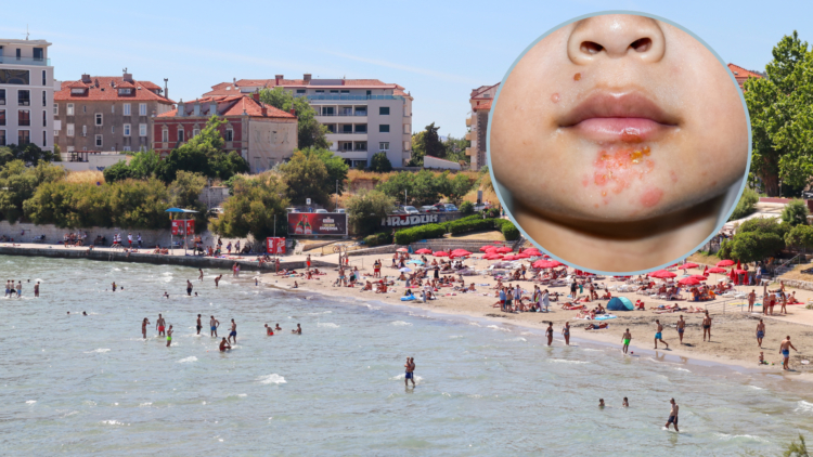 Na hrvatskim plažama pojavila se zaraza „slatke kraste“: Doktorka kaže da se lako širi