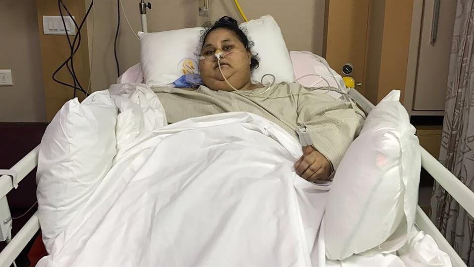 Najteža žena na svetu izgubila 250 kilograma nakon operacije