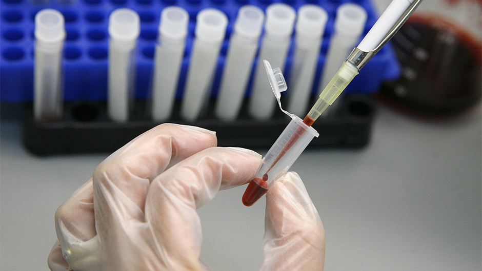 Naučnici: Analizom krvi moguće otkriti rak