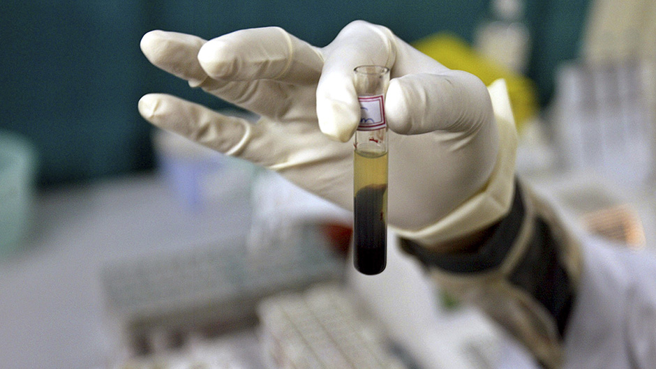 Naučnici otkrili kako da suzbijaju HIV virus