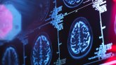 Nauka i mentalno zdravlje: Može li veštačka inteligencija da pomogne u lečenju Alchajmerove bolesti