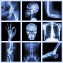 Neverovatan rendgenski snimak: Nestale kosti pacijentkinje