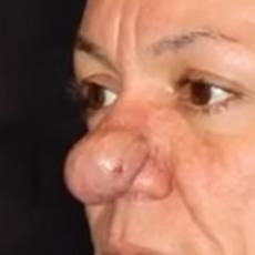 Nos nije prestajao da joj raste - onda je dobila operaciju koja joj je promenila ŽIVOT! (VIDEO)