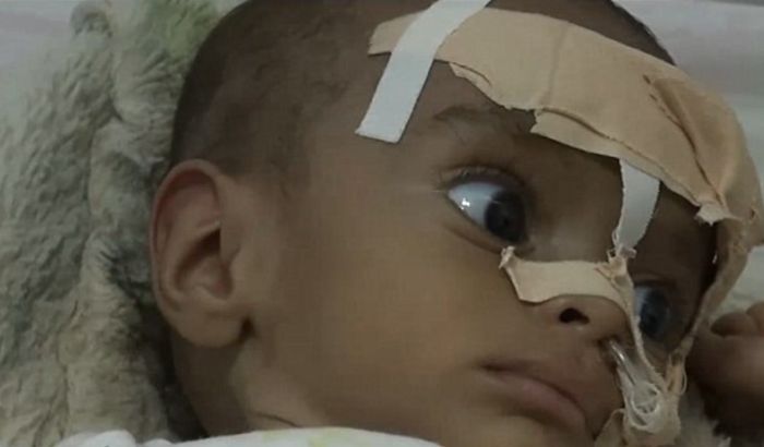 Od gladi svakog dana u Jemenu umre 130 dece