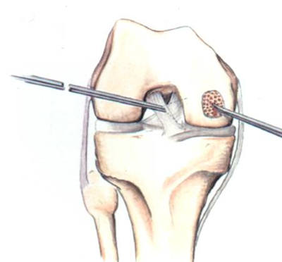 Operacija kolena