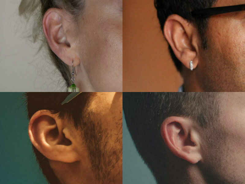 Operacija ušiju (Otoplastika)