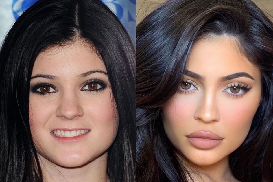 Operacije Kylie Jenner: Ona tvrdi da je zabluda da je izoperisana